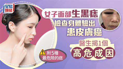 皮膚癌|Official Website